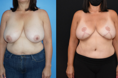 KS-DIEP-FLAP-Breast-Reconstruction