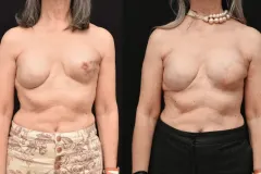 Latisimis-Flap-Before-and-After-Reconstruction-Copy-scaled