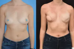 Latisimus-Flap-Reconstruction-Skin-Quality-scaled