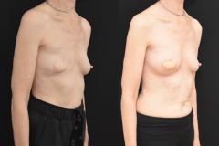 Latisimus-Flap-and-Implant-Mastectomy-Reconstruction-Three-Qurter-View