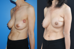 Left-Breast-Latisimus-Flap-Reconstruction