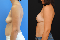 Mastectomy-Implant-Breast-Reconstruction-Side-Profile