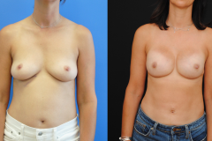 Mastectomy-Implant-Breast-Reconstruction-copy