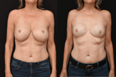 Mastectomy-Reconstruction-Brian-Dickinson-M.D