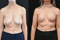 Mastectomy-Reconstruction-scaled