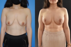 Mastopexy-Tissue-Expander-Implant-Reconstruction-Excellent-Result
