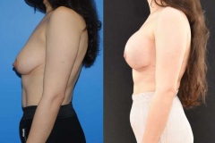 Mastopexy-Tissue-Expander-Implant-Reconstruction-Side-Profile-Excellent-Result