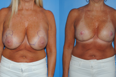 Mastopexy