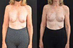 Oncoplastic-Breast-Reconstruction-IORT-and-removal-of-mammary-prosthesis.