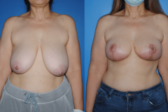 Oncoplastic-Breast-Reduction-Brian-P.-Dickinson-M.D.