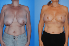 Oncoplastic-Reconstruction-of-Lumpectomy-Defects-Aesthetic-Breast-Reconstruction