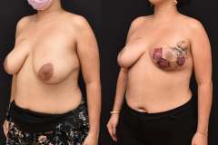 Oncoplastic-Reconstruction-of-Lumpectomy-Defects-and-Post-Operative-Tattoos