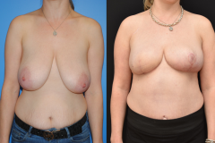 Right-Breast-DIEP-Flap-Breast-Reconstruction.-Breast-Reconstruction-Following-Mastectomy