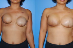 Tissue-Expander-and-Breast-Implant-Reconstruction