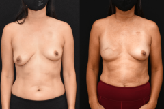 Unilateral-Nipple-Removing-Mastectomy