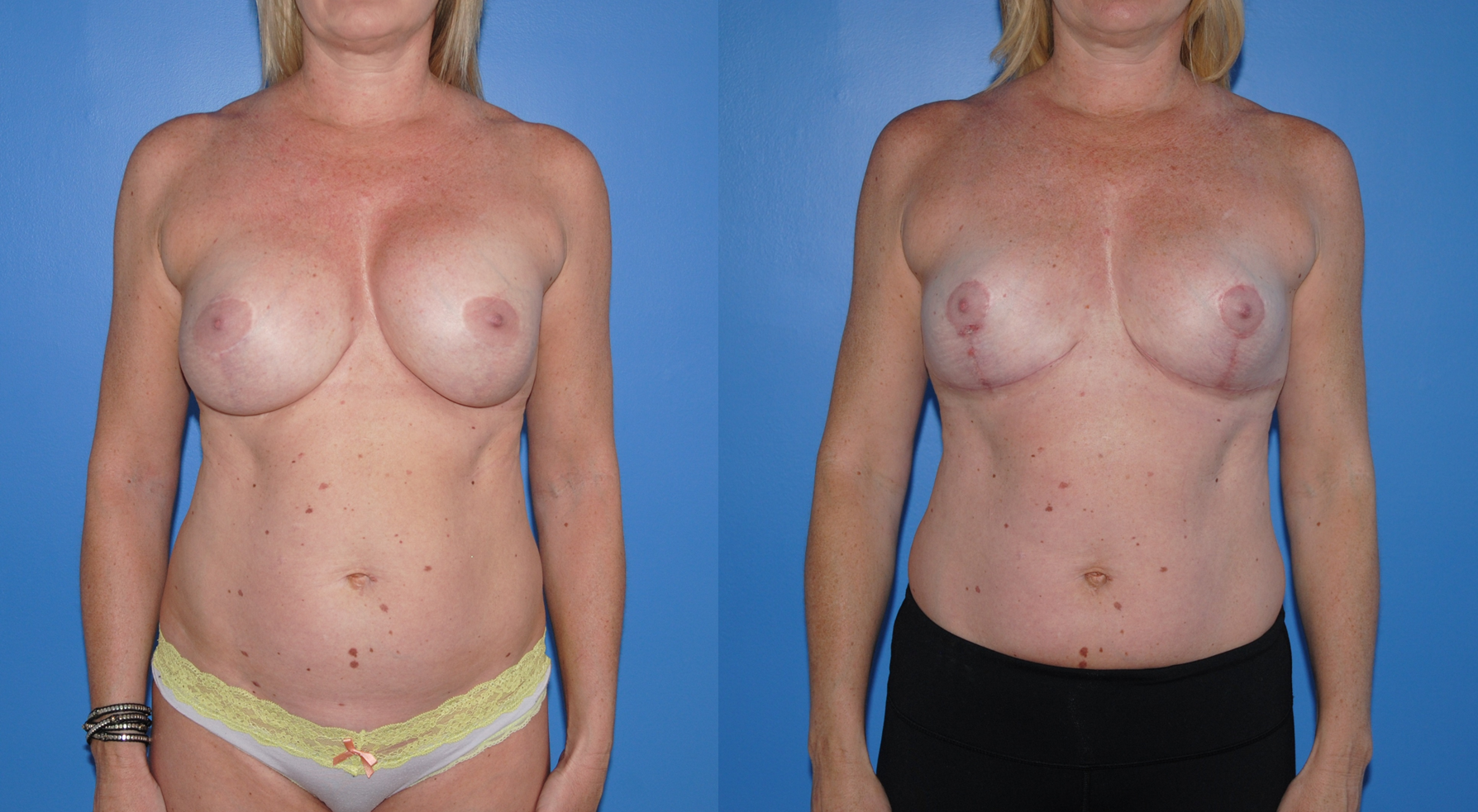 Downsizing Implants and Breast Lift