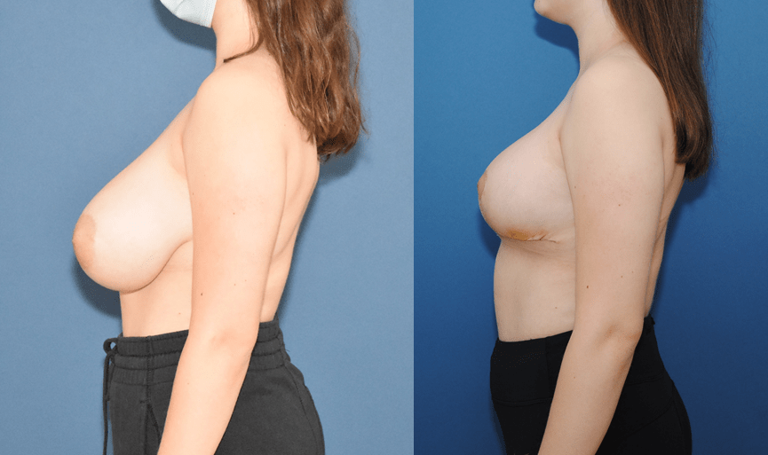 Breast-Reduction-Before-and-After-Side-Profile-Brian-Dickinson-M.D.