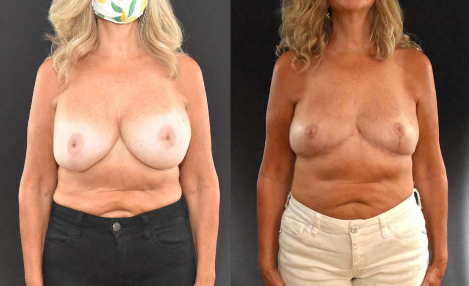 Removal-of-Breast-Implants-and-Mastopexy-Breast-Reduction-1