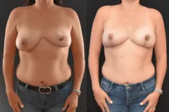 1_Breast-Asymmetry-Mastopexy-scaled