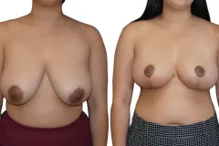 2_Breast-Reduction-Newport-Beach-Brian-P.-Dickinson-M.D-scaled