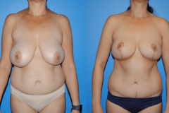 Abdominoplasty-Belly-Button-1