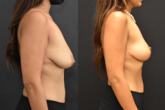 Bilateral-Mastopexy-Breast-Lift