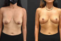 Bilateral-Mastopexy-Incision-Healing