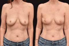 Breast-Cancer-Awareness-Month-Oncoplastic-Reconstruction-of-Lumpectomy-Defect-scaled