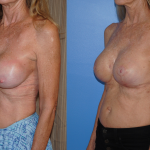 Breast Lift Augmentation Mastopexy