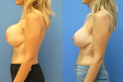 Breast-Reduction-Breast-Lift-Newport-Beach