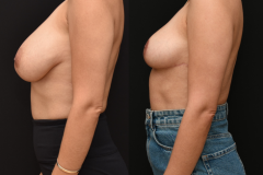 Breast-Reduction-Brian-P.-Dickinson-M.D.-Newport-Beach-CA