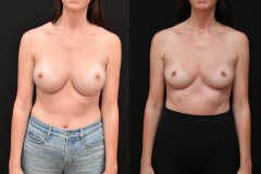 Implant-Removal-Brian-Dickinson-M.D