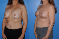 Implant-Removal-and-Breast-Lift-Oblique