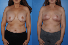 Implant-Removal-and-Breast-Lift