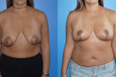 Lumpectomy-Defect-Reconstruction