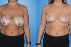 Oncoplastic-Reconsruction-Following-Lumpectomy