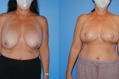 Oncoplastic-Reconstruction-and-Implant-Removal-Breast-Cancer-Lumpectomy