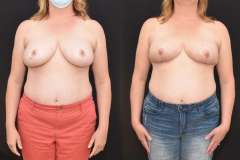 Oncoplastic-Reconstruction-of-Lumpectomy-Defect-Newport-Beach-Brian-Dickinson-M.D