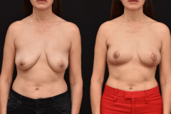 Oncoplastic-Reconstruction-of-Lumpectomy-Defects-Brian-P.-Dickinson-M.D.-Newport-Beach-California-Breast-Reconstruction-for-Website
