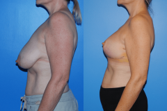 Oncoplastic-Reconstruction-of-Lumpectomy-Defects-Newport-Beach-Brian-Dickinson-M.D