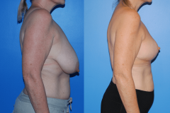 Oncoplastic-Reconstruction-of-Lumpectomy-Defects-Newport-Beach-Profile-Brian-Dickinson-M.D
