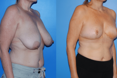 Oncoplastic-Reconstruction-of-Lumpectomy-Defects-Newport-Beach-Three-Quarter-View-Brian-Dickinson-M.D