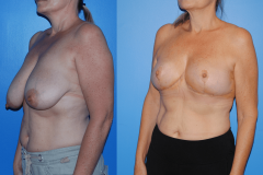 Oncoplastic-Reconstruction-of-Lumpectomy-Defects-Newport-Beach-Three-Quarter-View-Newport-Beach-Brian-Dickinson-M.D