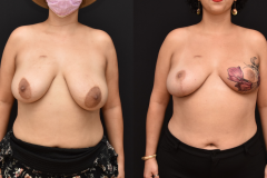 Oncoplastic-Reconstruction-of-Lumpectomy-Defects-and-Tattoo