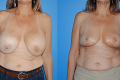 Oncoplastic-Reconstruction-of-Lumpectomy-Radiation-Defects