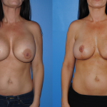 Removal-Replacement-Mastopexy