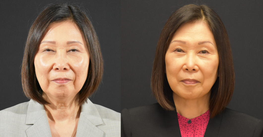 Lower-Face-Necklift-Before-and-After