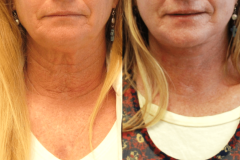 1_Lower-Face-Necklift-Dickinson