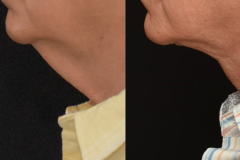 1_Lower-Face-Necklift
