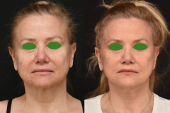 1_Lower-Face-and-Neck-Lift-Brian-P.-Dickinson-M.D-Newport-Beach-CA-Facial-Plastic-Surgery